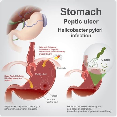 ULÇERA PEPTIKE - Klinika Digjitale