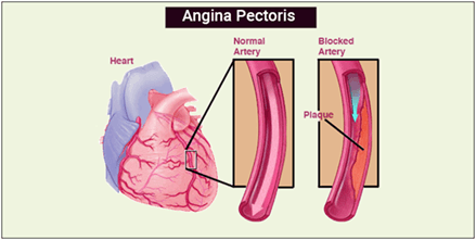 ANGINA PECTORIS - Klinika Digjitale