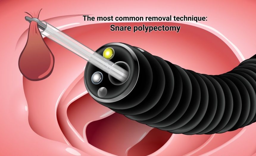 Snare Polypectomy - Klinika Digjitale